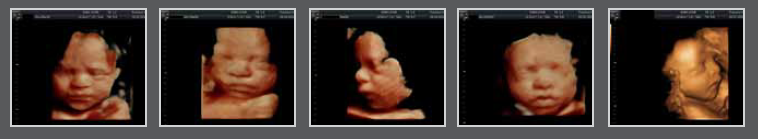 Baby Scans Precious Glimpse